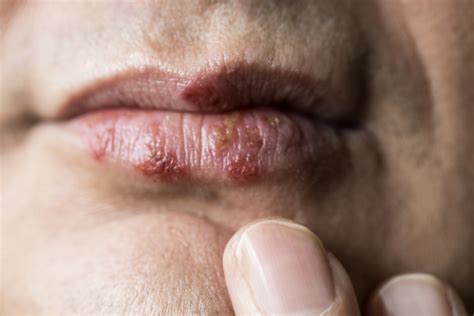 Herpes .